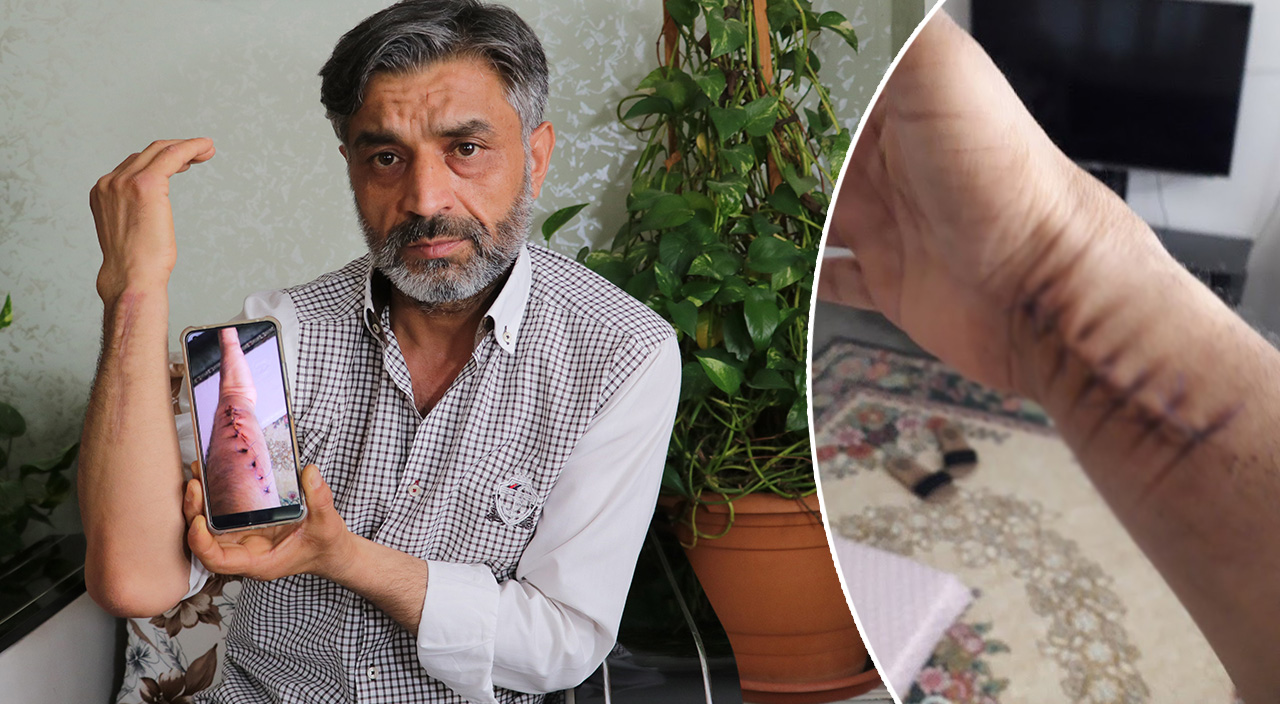 Yanlış ameliyat hayatını kabusa çevirdi: Elindeki şişlik için gitti... Koluna platin takıldı!