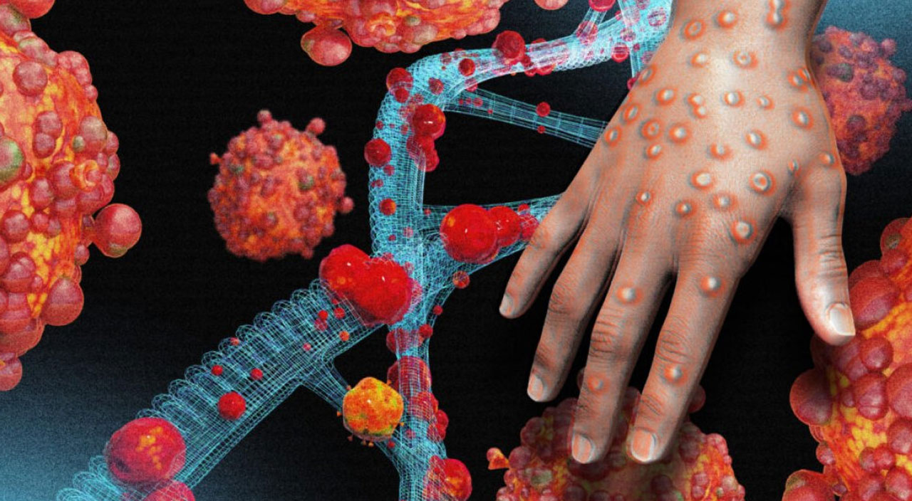 Maymun çiçeğinde son durum! Bakan Koca açıkladı: 5 vaka görüldü, 4 hasta iyileşti