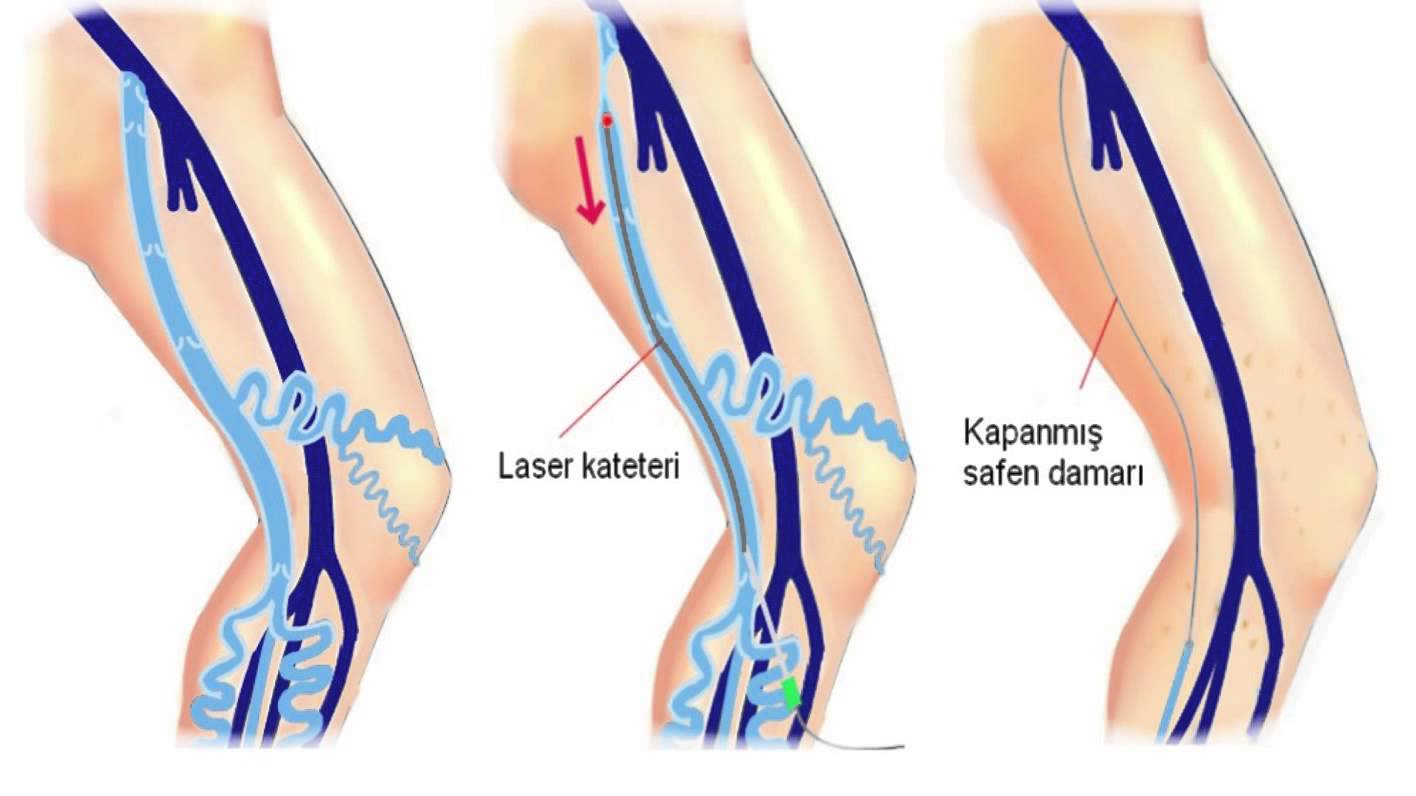 Varis neden olur? | Varis nasıl geçer?