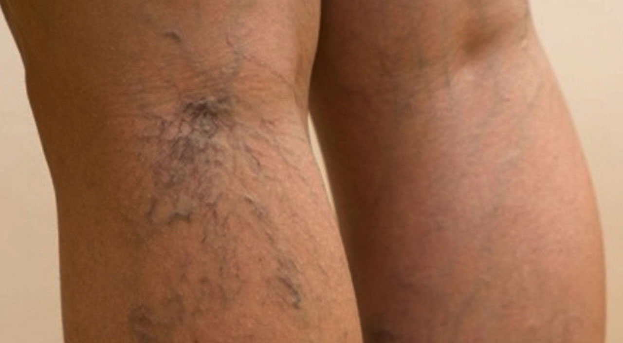 Görülme sıklığı arttı, uzmanlar uyardı: Varis için 5 risk faktörü! Varis neden olur, varisten nasıl korunuruz?