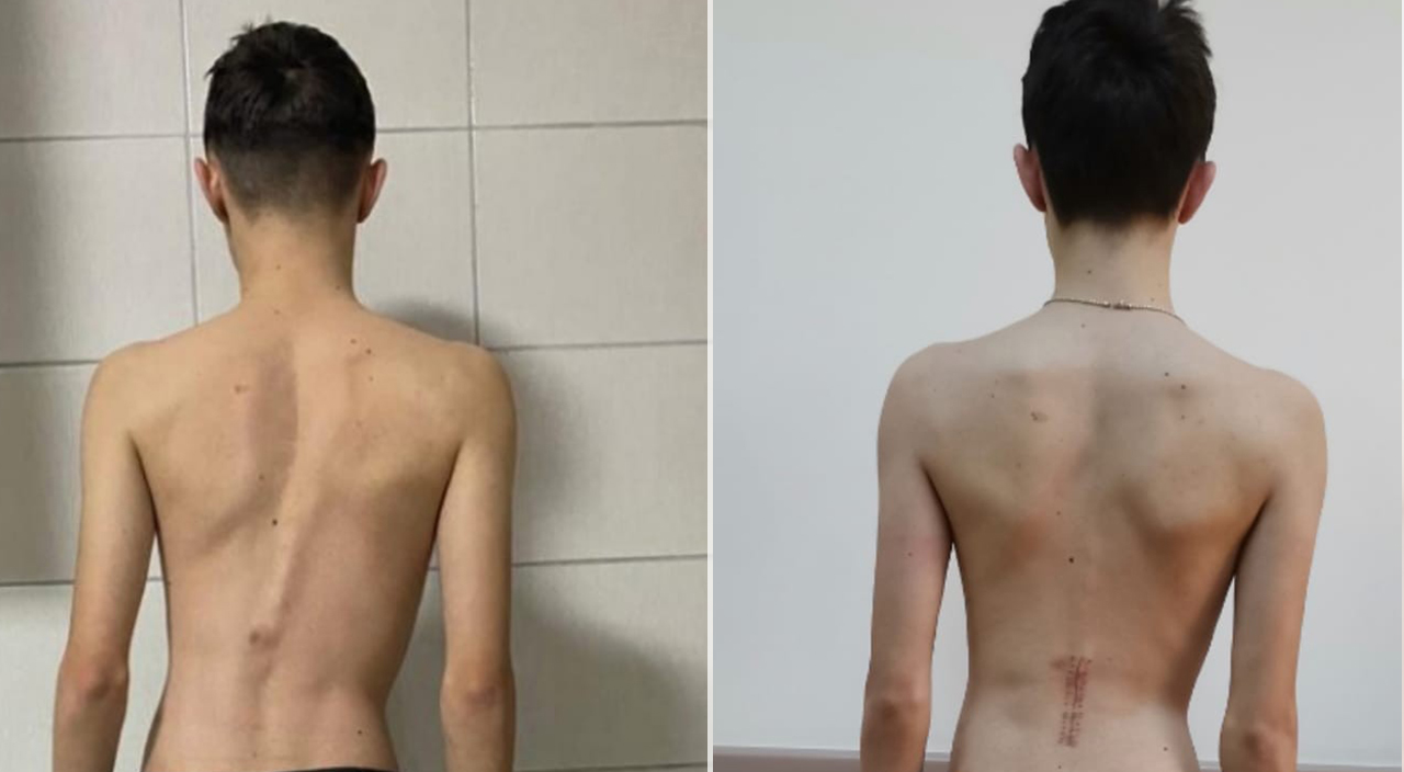 Bel ağrısı sandı tümör çıktı!