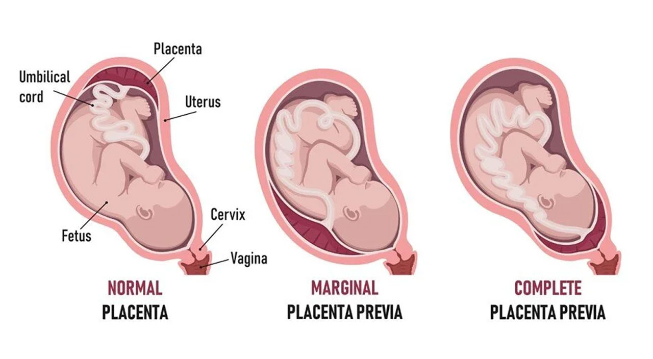Covid-19’lu hamile ölümlerinin nedeni bebeğin cinsiyeti olabilir!