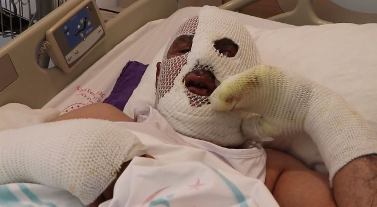 Lavabo açıcı yerine kimyasal ürün döktü, tüm vücudu yandı