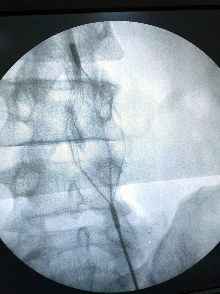Akciğer embolisinde yıllarca süren ilaç tedavisi 2 saatte sona eriyor