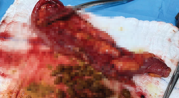 Karnından çıkanlar doktorları bile şaşırttı