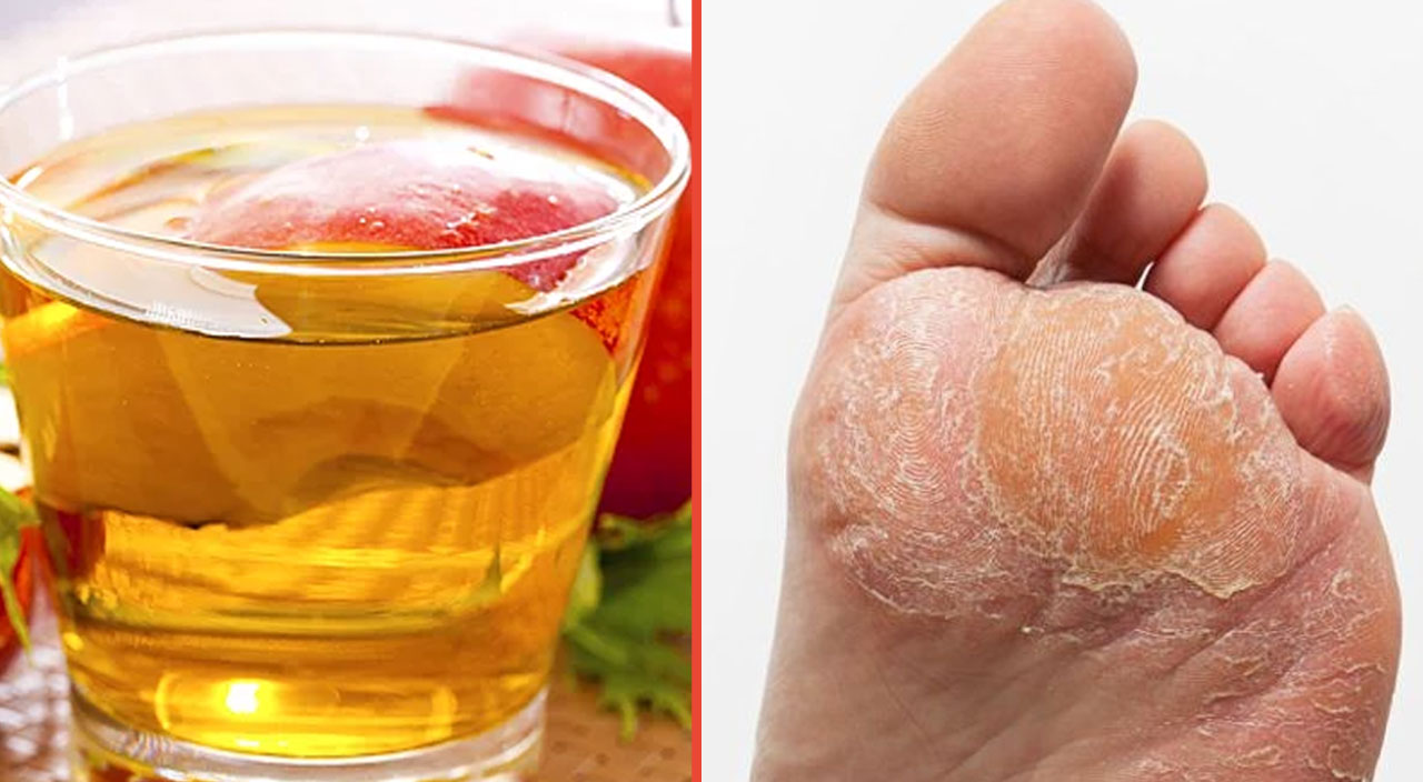 Ayak mantarına muhteşem &ccedil;&ouml;z&uuml;m: Deneyenler bir gecede kurtuluyor! İşte ila&ccedil; gibi tavsiye&hellip;