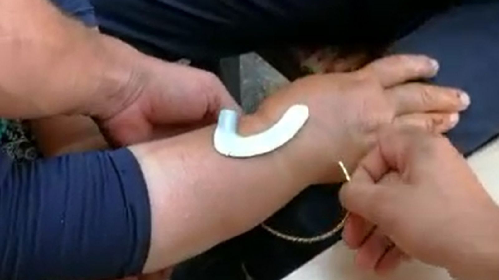 Şişen bileğindeki bileziği itfaiye ekibi keserek çıkardı