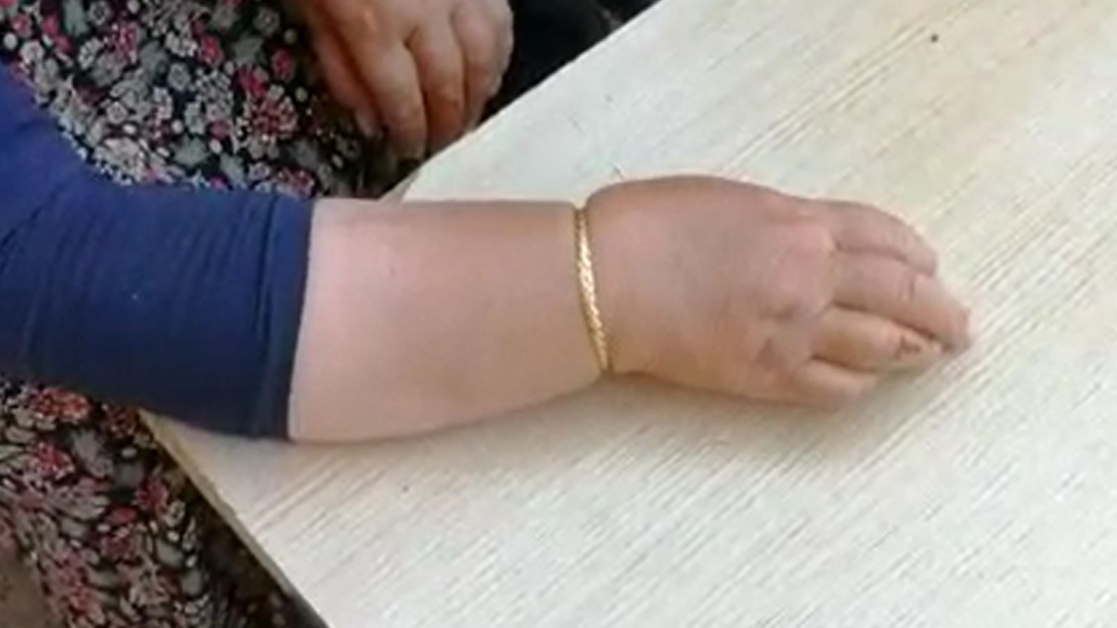 Şişen bileğindeki bileziği itfaiye ekibi keserek çıkardı