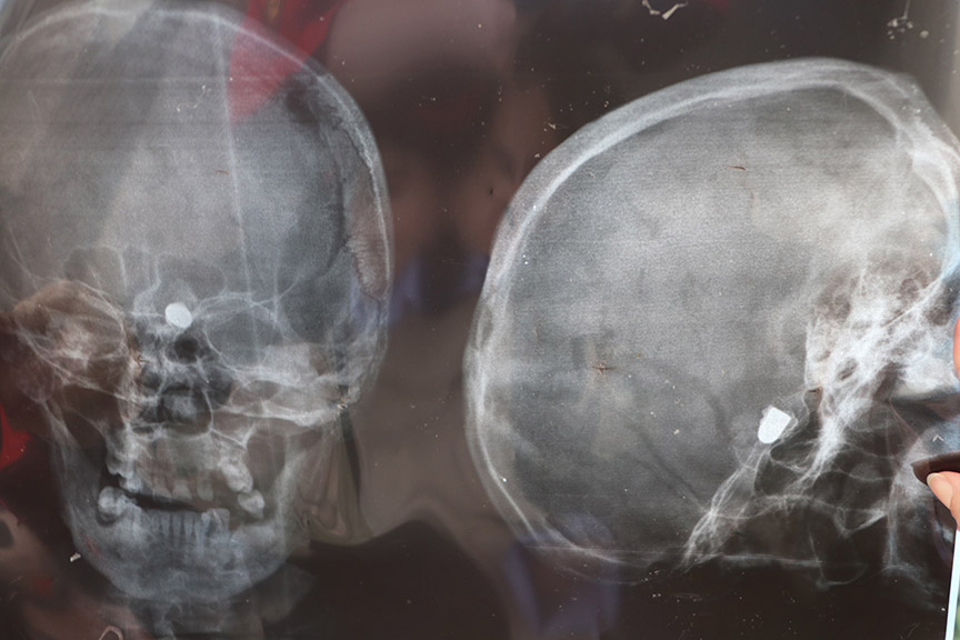 45 yıldır kafasındaki kurşunla yaşıyor