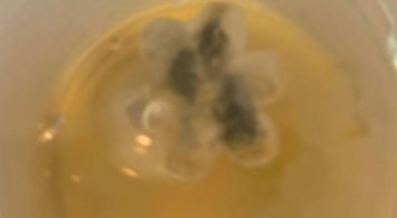 Sürekli öksürüyordu, 5 sene astım tedavisi gördü: Asıl nedeni bambaşka çıktı