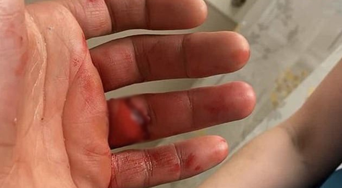 Karma dövüş sporcusunun maç sırasında parmağı koptu