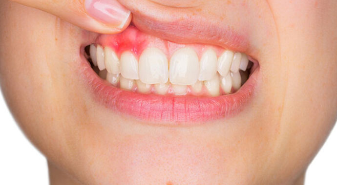 Diş ağrısı nasıl geçer? | Diş ağrısı için evde tedavi yöntemleri | Diş eti neden kanar? | Diş çürüğünün zararları neler?