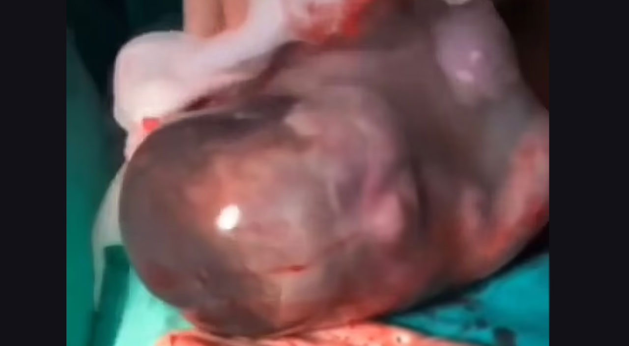 80 binde bir oluyor: Amniyotik kesede doğan bebekler doktorlar bile şaşırttı