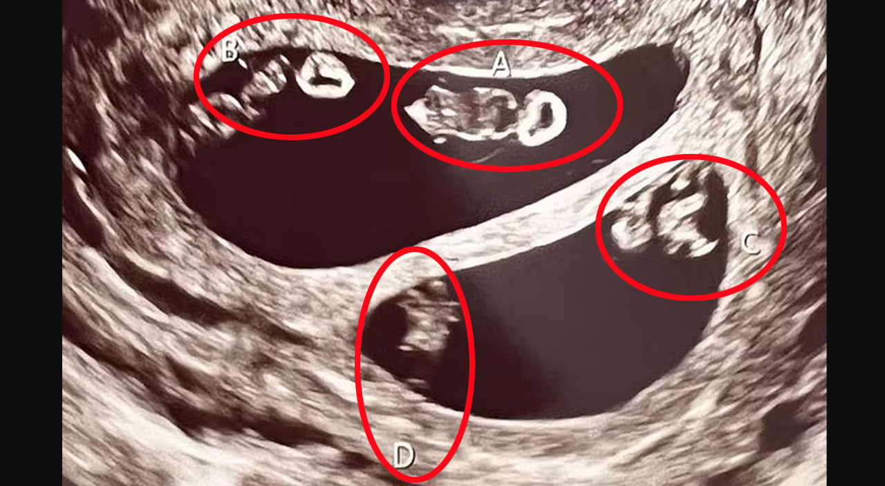 70 milyonda bir ihtimal: Anne adayı aynı anda iki ikiz bebek bekliyor