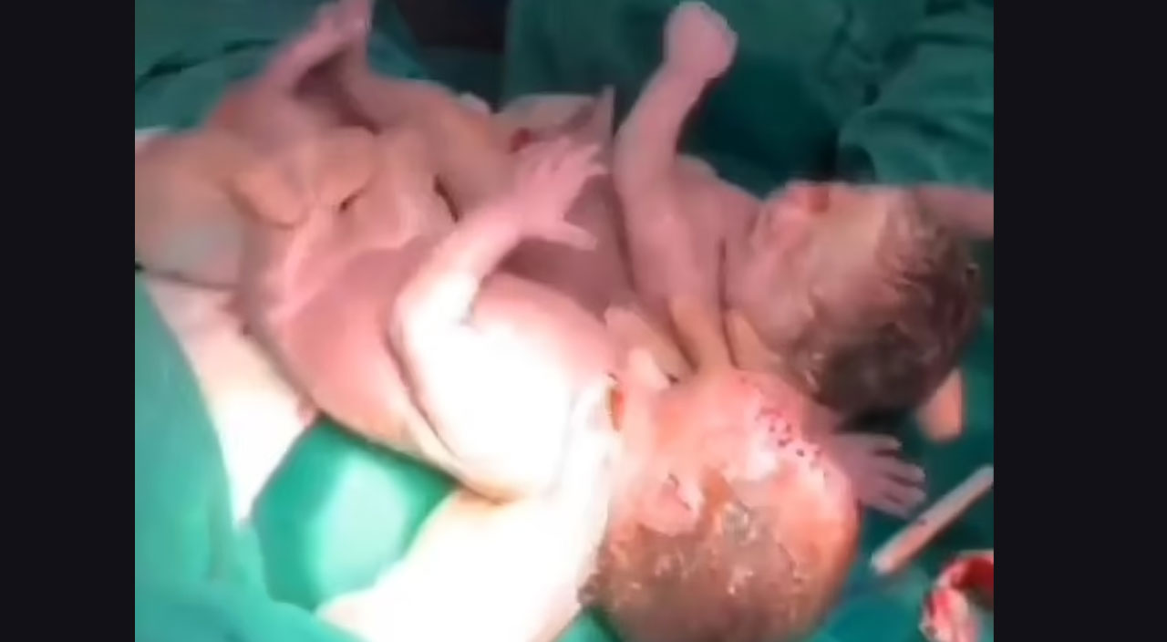 80 binde bir oluyor: Amniyotik kesede doğan bebekler doktorlar bile şaşırttı 80 binde bir oluyor: Amniyotik kesede doğan bebekler doktorlar bile şaşırttı