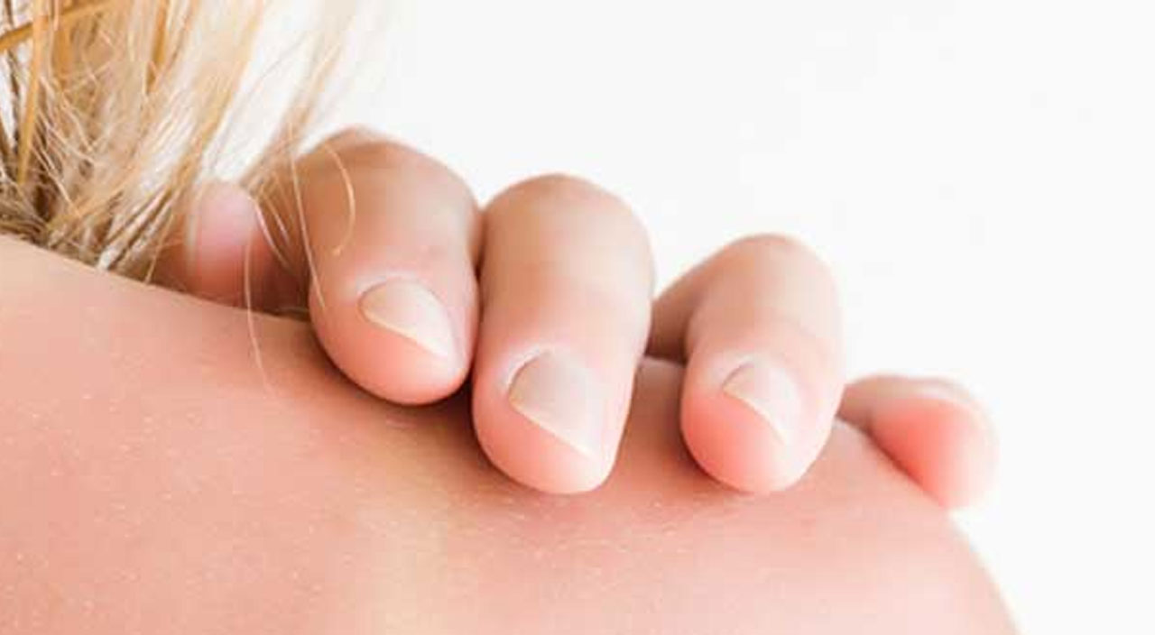 Doğru bilinen yanlış: Uzmanlar uyardı, güneş yanıklarına asla yoğurt sürmeyin