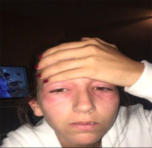 Pikniğe gitti, gözlerinden oldu