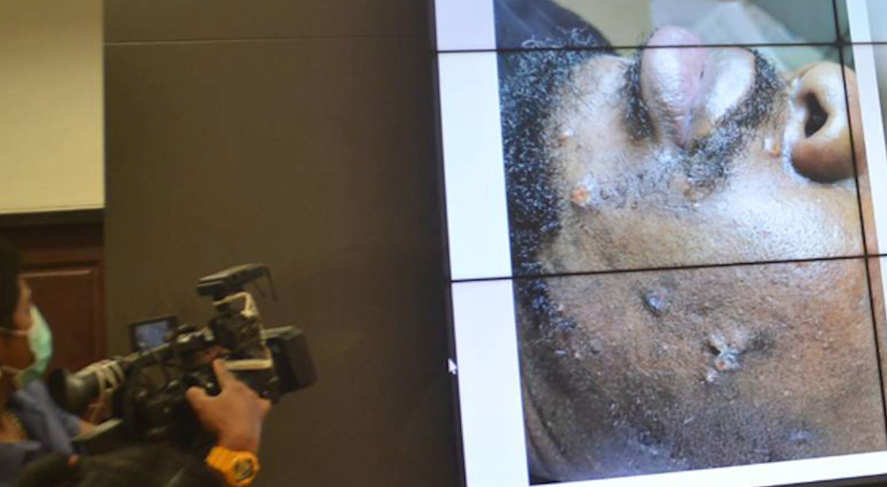 Tayland’ın ilk maymun çiçeği vakasıydı... Başka ülkeye kaçtı!