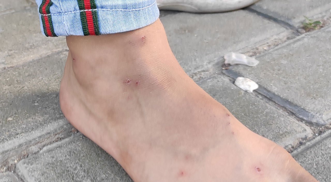 İstanbul'da 'Aedes' istilası: Isırdığı yer yara ve enfeksiyon oluyor