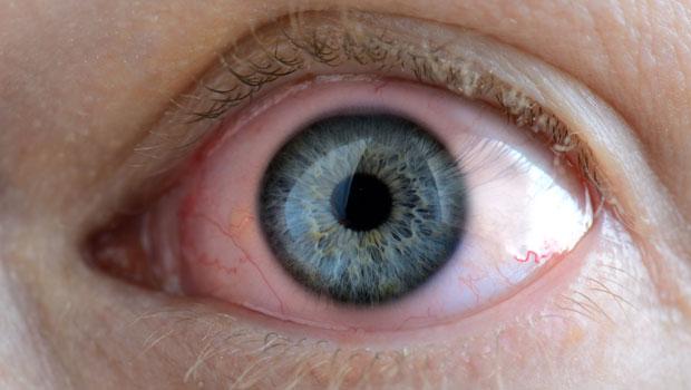 Gözde kırmızılık niye olur, gözlerdeki kırmızılık hastalık belirtisi mi?