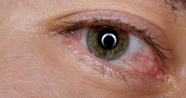 Gözde kırmızılık niye olur, gözlerdeki kırmızılık hastalık belirtisi mi?