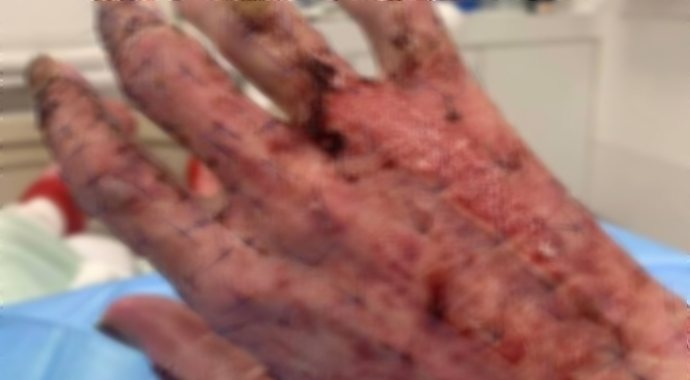 El dezenfektanı kullanıp çakmak çakınca…