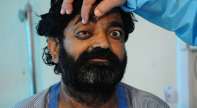 Covid-19'u atlatanlarda görüldü: Hindistan'da 'siyah mantar' kabusu