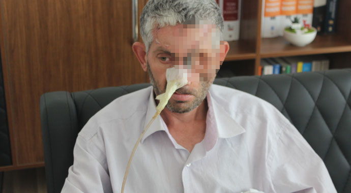 Hayret veren olay! Dişini çektirdi, gözünü kaybetti