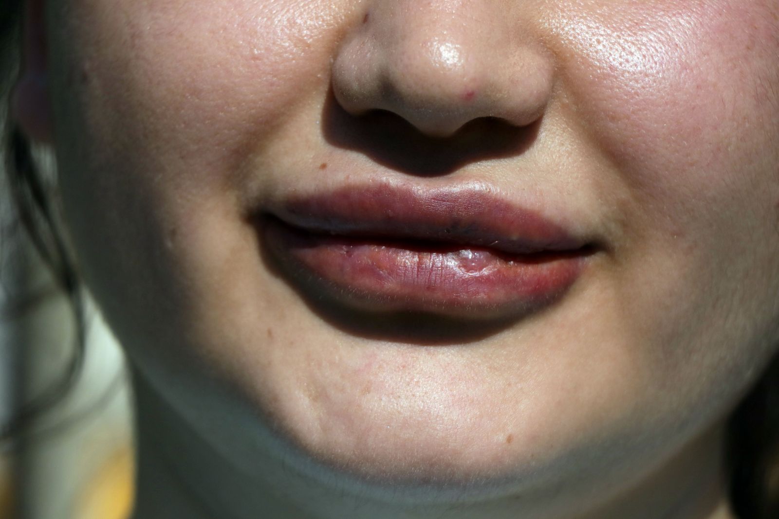 Dudak silikonu mağduru hemşire taburcu edilecek, işte son hali