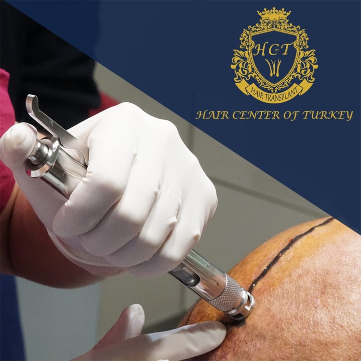 Hair Center of Turkey'de ağrısız ve tıraşsız saç ekimi ayrıcalıklarını yaşayın