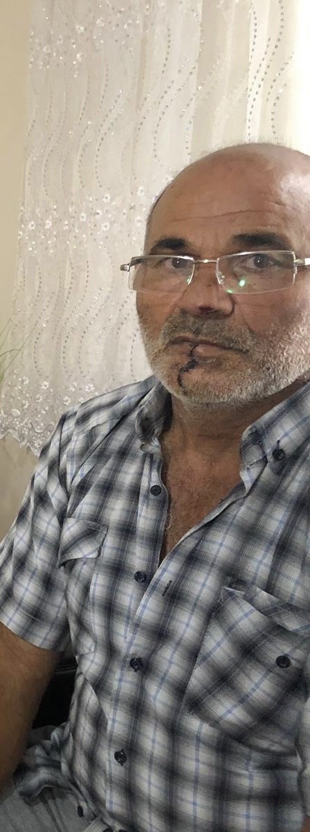 'Hannibal' damat, kayınpederinin dudağını böyle parçaladı