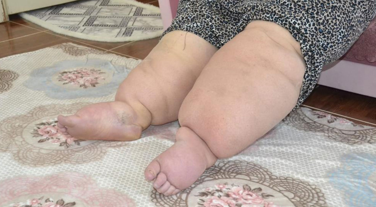 Hayatı kabusa döndü! Bacakları günden güne şişiyor, 15 yıldır hastalığına teşhis konulamıyor
