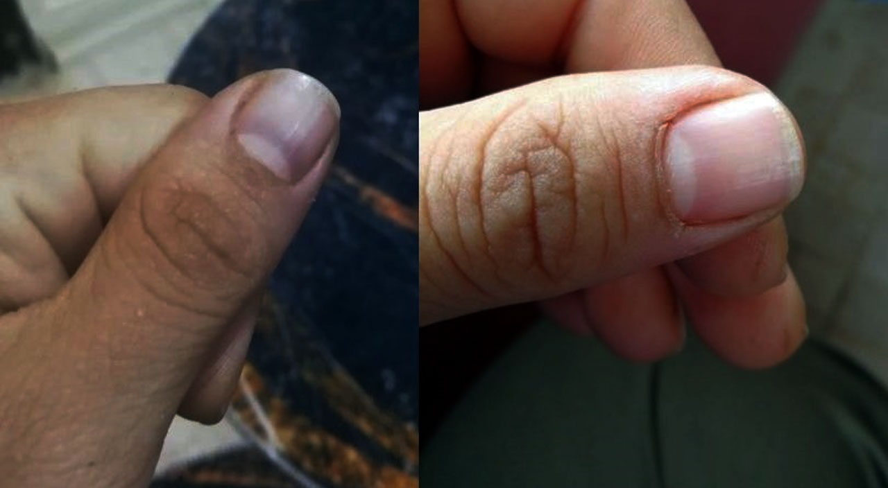 Hastalığının adı bile yok! Elleri, ayakları, dudakları sürekli morarıyor