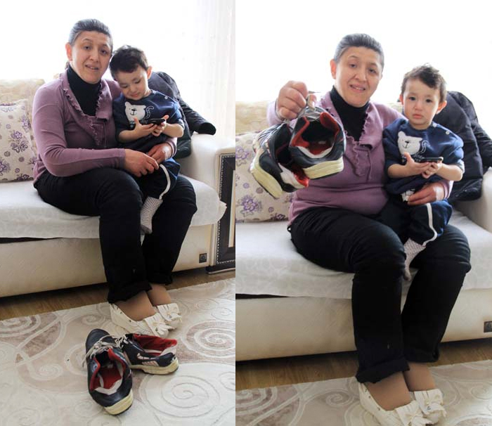 31 yıl sonra fil hastalığını yendi 31 yıl sonra fil hastalığını yendi