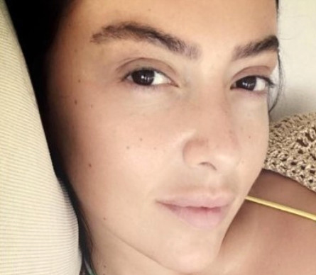 Hadise kaşına saç ektirdi