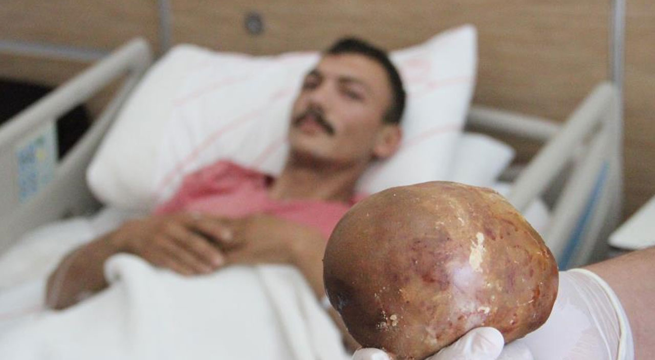 Yanma şikayetiyle doktora gitti, vücudundan çıkan şey doktorları hayrete düşürdü