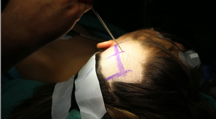 Genç hemşireyi felç olmaktan kurtaran operasyon