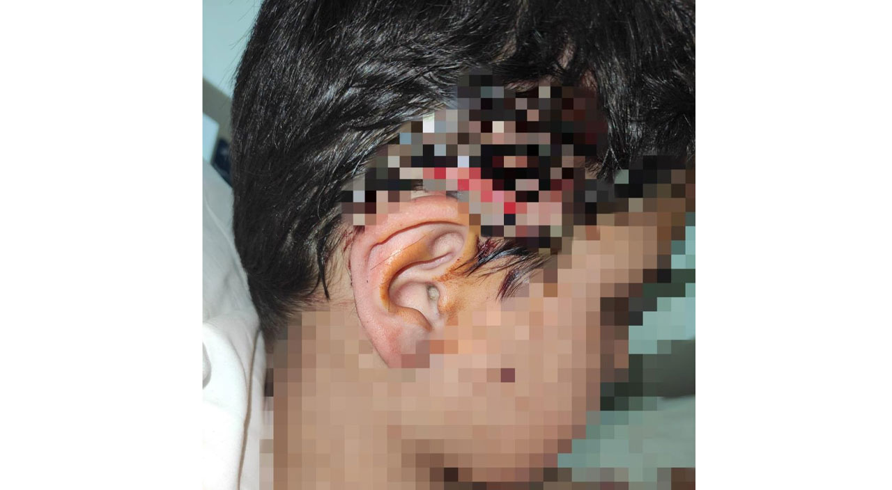 Sokak köpeği terörü devam ediyor: Okula giden 10 yaşındaki çocuk hastanelik oldu