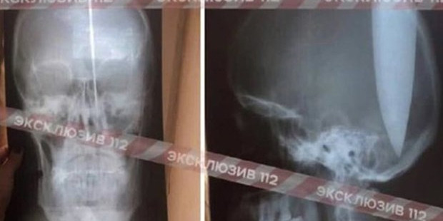 Burnu tıkanınca nefes almak için kafasını deldi! Burnu tıkanınca nefes almak için kafasını deldi!