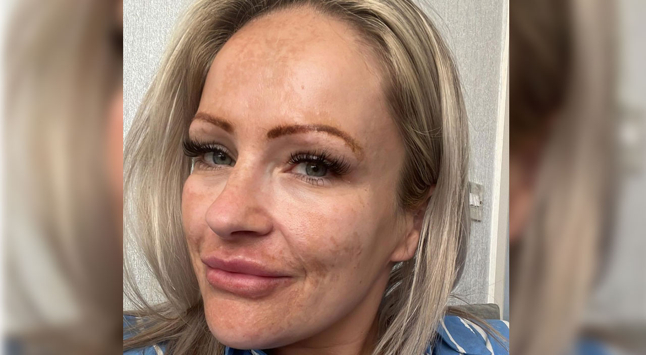 Bronzlaşma bağımlılığı kafasında delik açtı… Şimdi herkesi uyarıyor