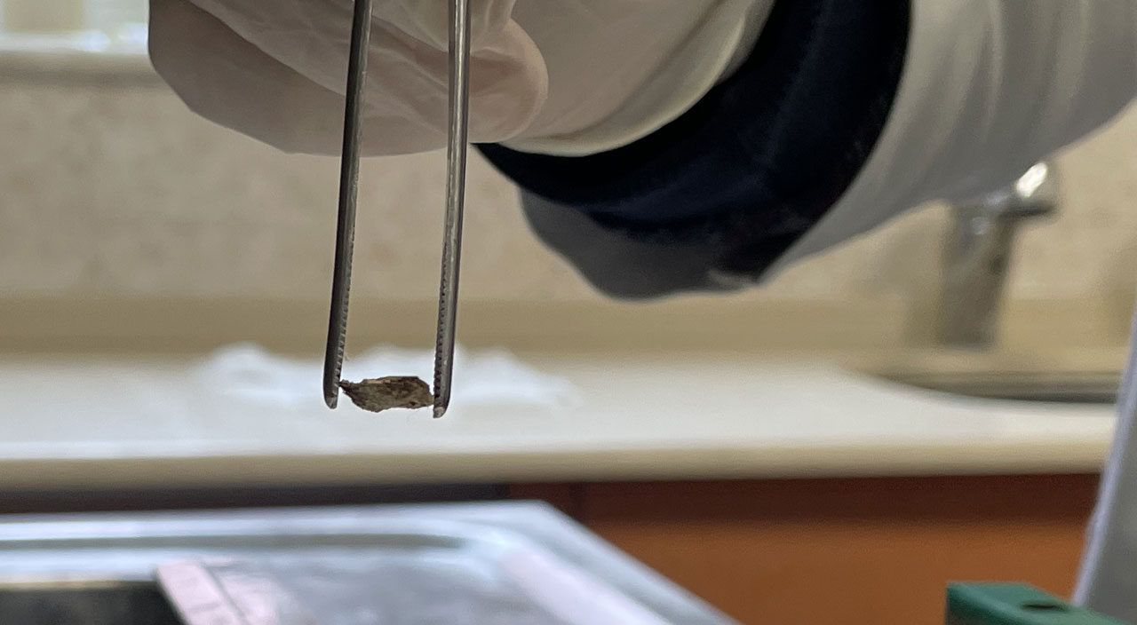 Kanser sanılan hastanın soluk borusundan çıkan şey şoke etti: Bir daha yemeyeceğim