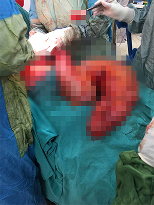 Karnından çıkana doktorlar bile inanamadı!