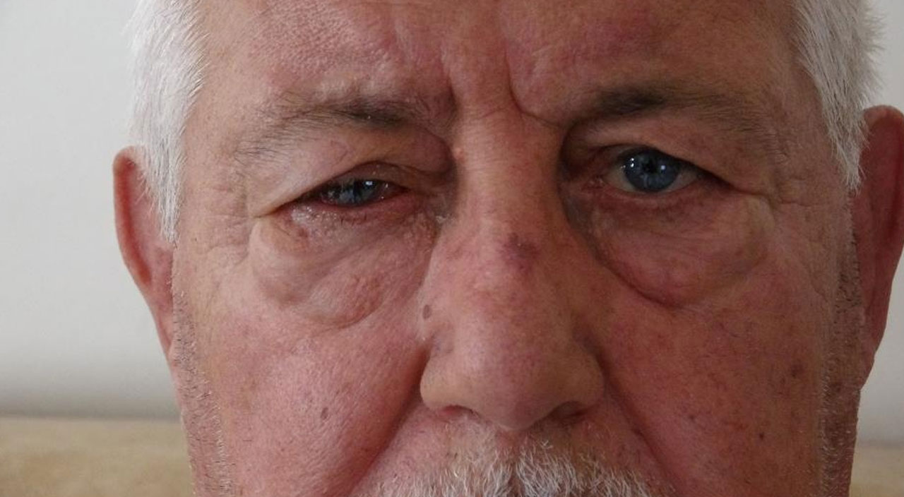 Katarakt ameliyatı için gittiği hastanede hayatının şokunu yaşadı Katarakt ameliyatı için gittiği hastanede hayatının şokunu yaşadı
