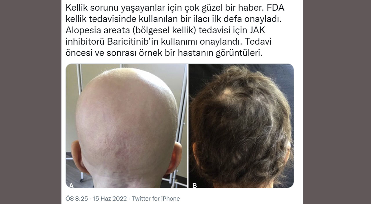 Türk doktor fotoğrafları paylaşarak müjdeyi verdi: FDA’dan kelliğe karşı geliştirilen ilaca onay geldi Türk doktor fotoğrafları paylaşarak müjdeyi verdi: FDA’dan kelliğe karşı geliştirilen ilaca onay geldi