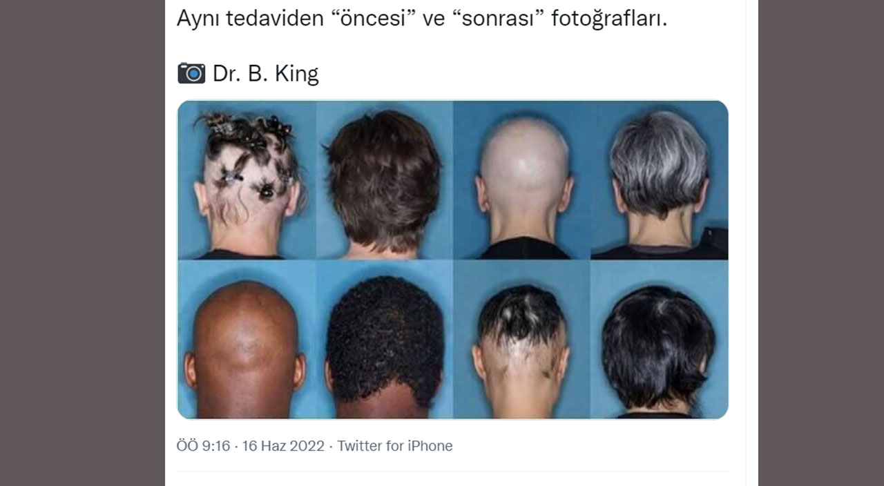 Türk doktor fotoğrafları paylaşarak müjdeyi verdi: FDA’dan kelliğe karşı geliştirilen ilaca onay geldi Türk doktor fotoğrafları paylaşarak müjdeyi verdi: FDA’dan kelliğe karşı geliştirilen ilaca onay geldi