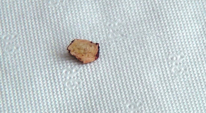 Çorba içerken akciğerine kaçan kemik 3 yıl sonra fark edildi