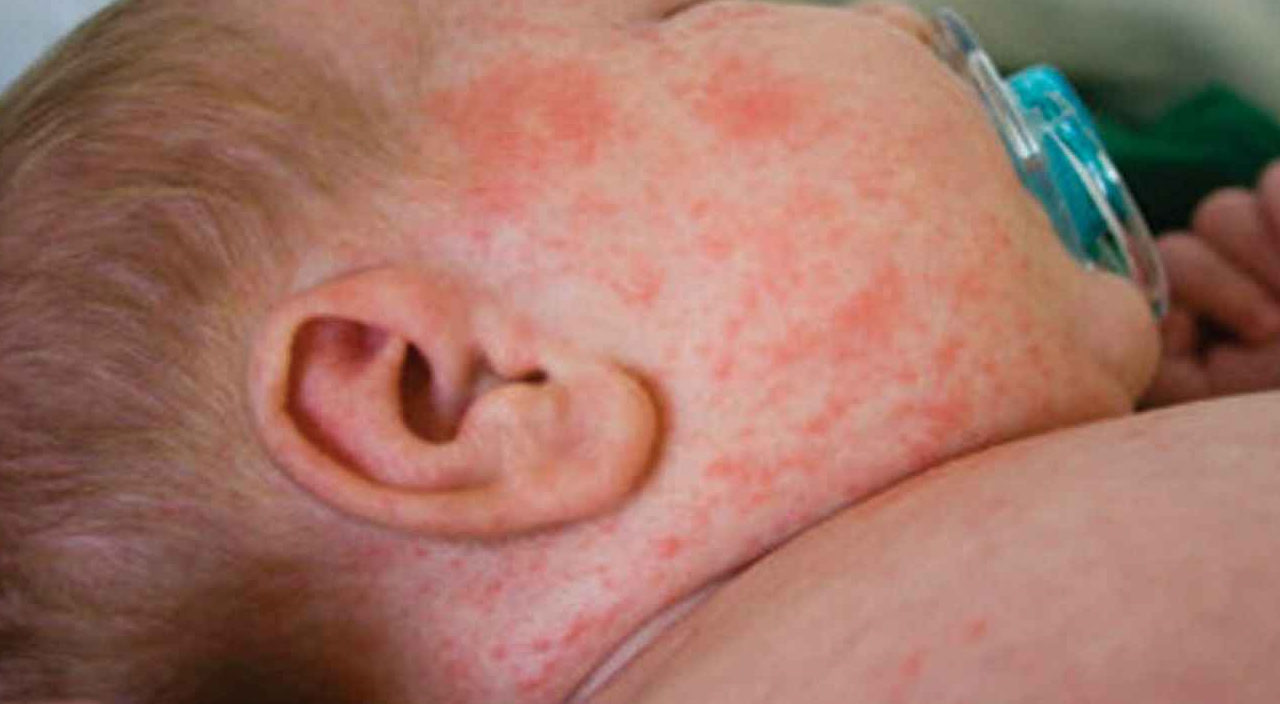 Koronavirüsün ardından kızamık vakaları %80 arttı… Yeni salgın kapıda!