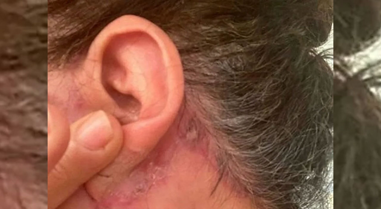 Antalya'da estetik faciası! Güzelleşmek isterken burun kemikleri eridi ve genzine düştü