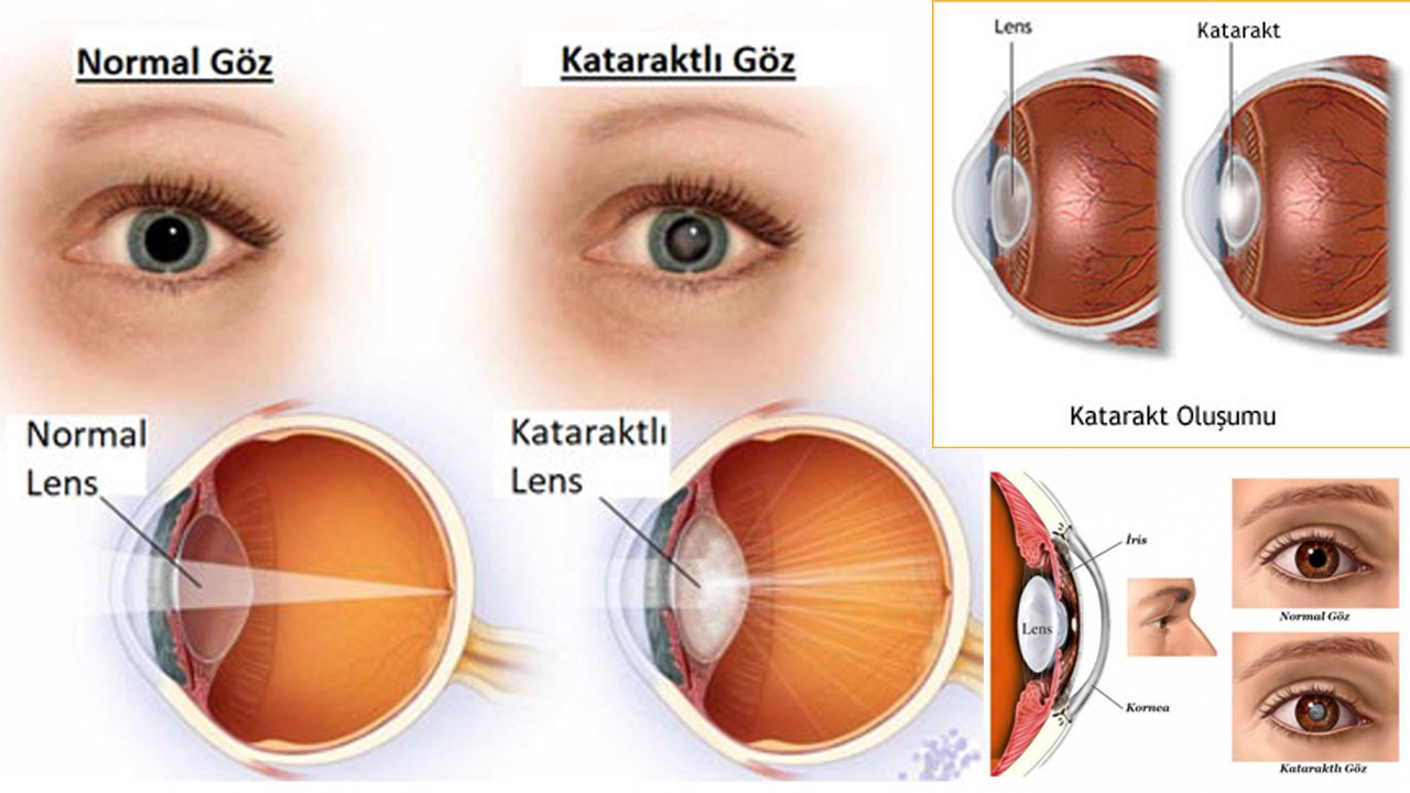 Uzmanlardan kritik uyarı: Korona virüs görme kaybına da neden olabiliyor