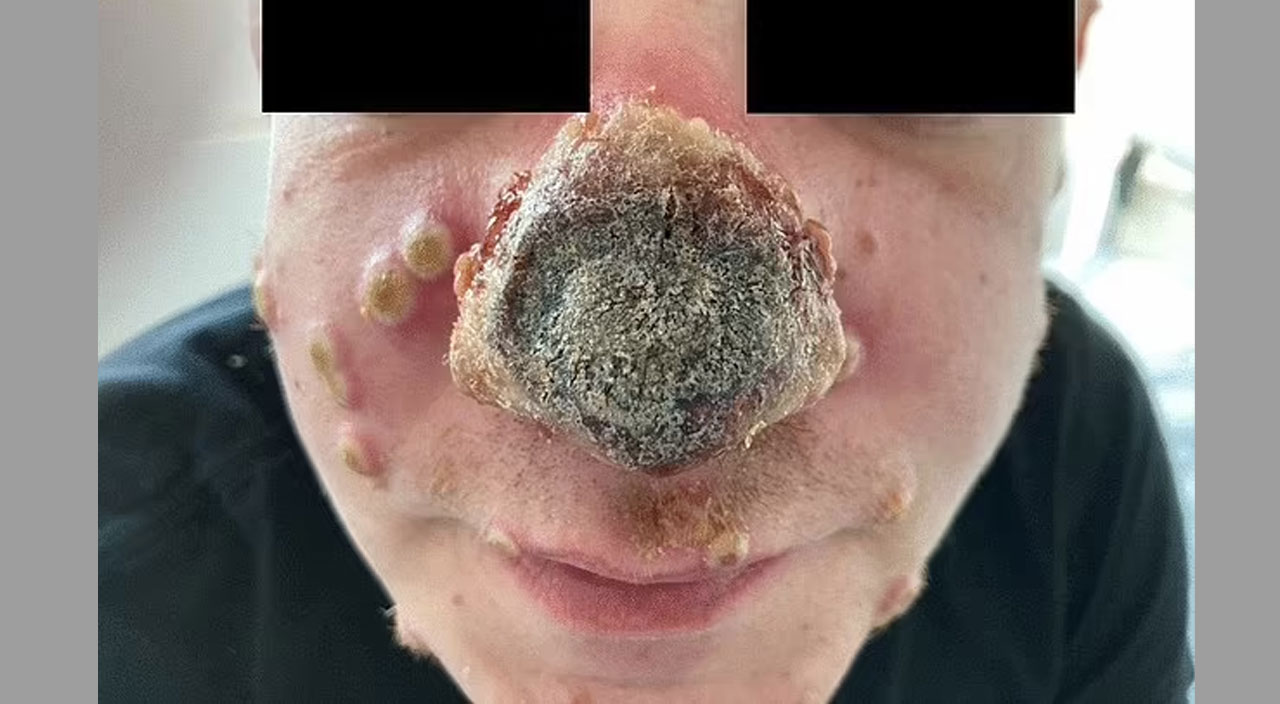 Güneş lekesi sandılar, maymun çiçeği çıktı: Üç günde burnu çürüdü!